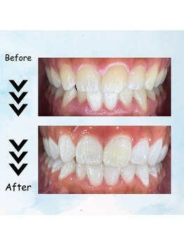 エクシアホワイトニング 塩釜口駅前店/20代前半の女性の効果事例