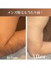 【男性全身脱毛360℃】(顔またはVIO）スピード脱毛　