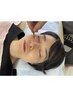 お目元すっきりフェイスポインター的な【刺さない美容鍼】30分　2000円