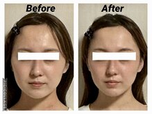 ショウフェイスデザイン(Sho Face Design)/《小顔矯正》ビフォーアフター