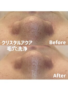 ブルームーン(BLUE MOON)/毛穴洗浄