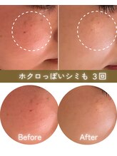 ココロ(COCORO)/シミケア機3台でアプローチ！