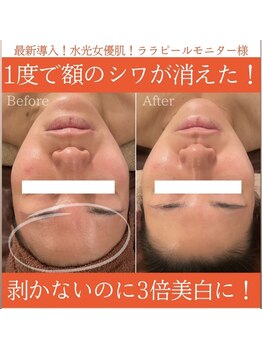 アリュールビューティー 下高井戸店(ALLURE BEAUTY)/ツヤ肌ララピール★