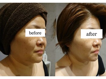 ビー ブルーム(B BLOOM)/【リフトアップ小顔】