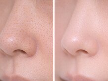 ルナ クレッシェンテ(Luna crescente)/毛穴ケア専門店級の毛穴洗浄ケア