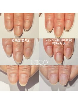 ニコプラス(NICO+)/自爪育成中
