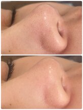 プリエ(BRILLER)/毛穴ケア