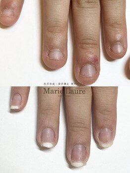 マリーロール 梅田店(Marie Laure)/自爪育成/深爪矯正/ネイルケア