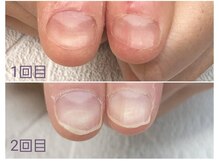 グレースレディ/(深爪/長さだし/フィルイン/)