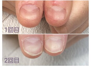 グレースレディ/(深爪/長さだし/フィルイン/)