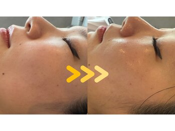 ミトノウ(MITONOU)/エアセラム ビフォーアフター