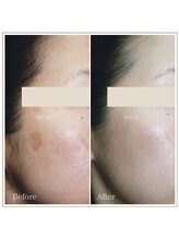 ベルタ(BELTA)/ケア前→4ヶ月後　シミ