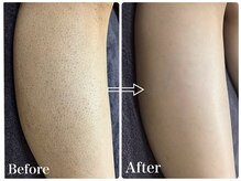 ハダハダ(HADA HADA Medical Esthetic)の雰囲気(毛穴レス脱毛♪美脚へ大変身♪)