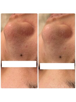 メゾンリュバン 天王寺(Maison Ruban)/毛穴洗浄・美白フォト|毛穴ケア