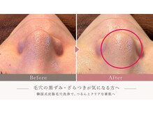 ミヨン(美Yong)の雰囲気（1回の施術後　毛穴洗浄）