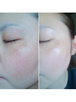 アルクラール/韓国式☆塗る“針美容”