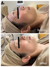 ジャスミン(Jasmin)/臍帯血幹細胞×NMN×AC-11