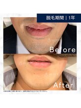 メンズクリア 上水戸ドンキ店/【メンズクリア】お客様の施術例