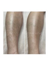 ヒロット タオ(HILOT TAO)/Sugaring 脚脱毛