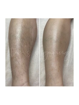 ヒロット タオ(HILOT TAO)/Sugaring 脚脱毛