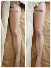 ラプタス(Rapu+)/O脚、X脚にも効果的