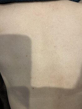 ソイ(soi)/脱毛スタート