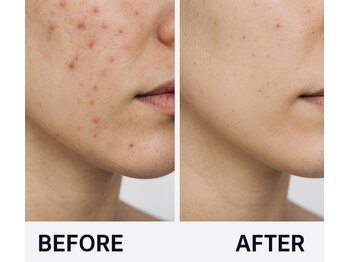 アメノチハレ(ame nochi hare)/肌に合わせたハーブピーリング!