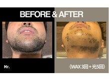 ミスター(Mr.)/【光×ワックス脱毛】