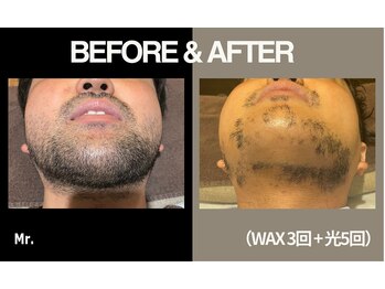 ミスター(Mr.)/【光×ワックス脱毛】
