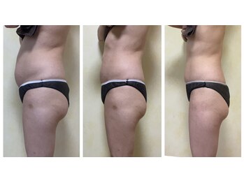 マハロ スコータイ/ビフォーアフター　＜腰＞