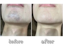 メンズ スリーク(Men's SLEEK)/【ヒゲ脱毛】Before→After