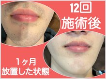 ファシネイト 新宿本店(Fascinate)/ヒゲ脱毛【メンズ脱毛/新宿】
