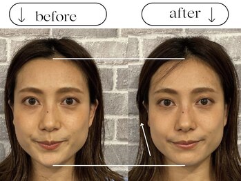 ビースタイル(B-style)/電気美容鍼ビフォーアフター