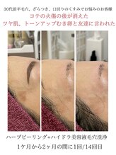 GRACETHOUSAND(グレイスサウザンド)/ハーブピーリング/洗浄/シミケア