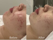 リフコウベ(LIF KOBE)/アンストレス1回◇2週間後