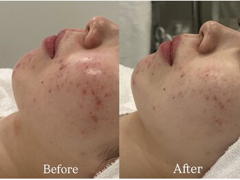 リフコウベ(LIF KOBE)/アンストレス1回◇2週間後