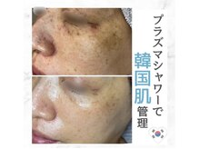 美容液導入で肝班改改善◎