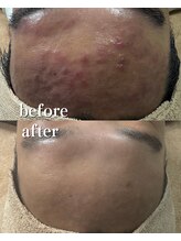 オーシャンハーブ(Ocean Harb)/【ハーブピーリングで赤み改善】