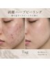 No.1 何をしても改善しなかった方へ!本気のニキビ/跡/毛穴改善￥55000→￥12980