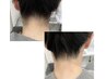 【大人気！】うなじ脱毛！スッキリ首長効果も！　¥4500→¥3000