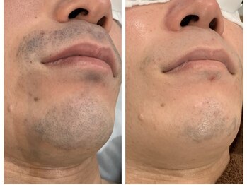 ケイ(Kei)/男性☆ひげ脱毛before /after 