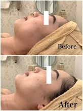 スペチアーレ 夙川/話題の炭酸ピーリング