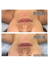 レイモード(Ray mode)/BBLフェイシャルトリートメント