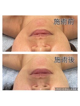 レイモード(Ray mode)/BBLフェイシャルトリートメント