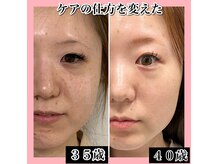 マイン 豊中(Mine)の雰囲気（最強成分NMN入れた幹細胞ハーブピーリング/豊中/ララピール）