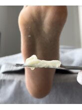 フットミー(foot mii)/これは角質