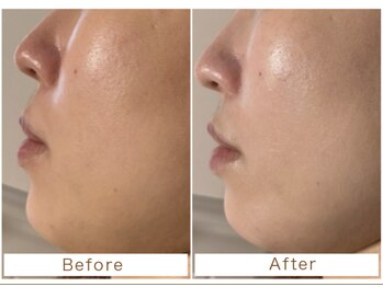 ビーエックス(.BX)/磁気復元パックBefore/After