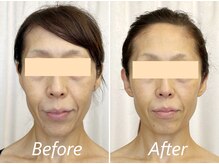 ドクターボディ 新宿店(Dr.Body)/【中顔面/人中/たるみ　50代】