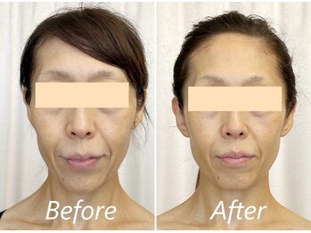 ドクターボディ 新宿店(Dr.Body)/【中顔面/人中/たるみ 50代】