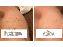 ラディアンス/シミケアフェイシャル　BA２